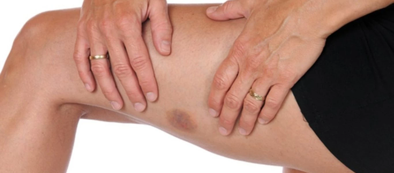 Όλα όσα πρέπει να γνωρίζετε για τις μελανιές - Γρήγορες φυσικές λύσεις για να τις θεραπεύσετε